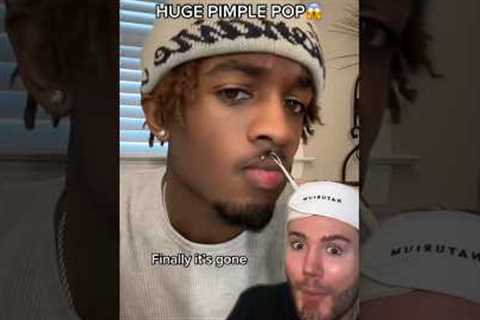 HUGE PIMPLE POP!😱 #acne #skincare #skincareroutine #beauty #acnetreatment #pimplepopping #skin