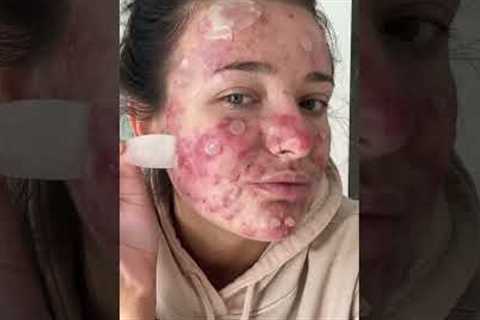 Best Fazit’s Pimple Patch Peels! #acneproneskin #acne #acnepositivity #pimplepopper #pimplepatch