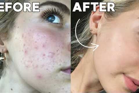 How I Cleared My Skin In 8 Weeks *naturally*