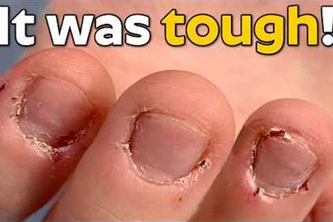 Bitten Nails &amp; Extremely Dry Cuticles Transformation with Acrylic