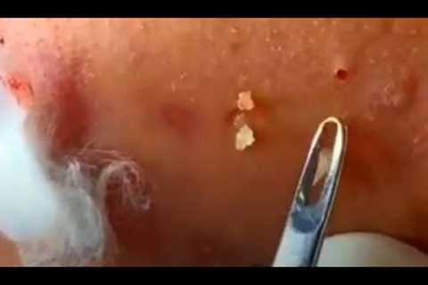 Acne, closed scalp, dry skin, acne on the left cheek, how to pop a pimple (60)