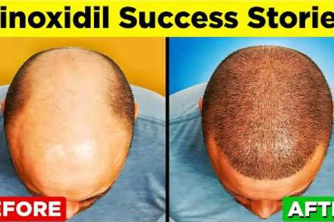 MINOXIDIL - A Step-by-Step Guide to Regain Your Hair