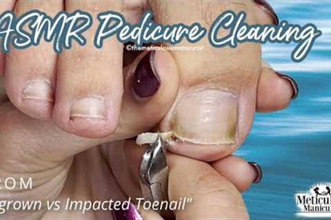 👣ASMR Pedicure Cleaning💆‍♀️Ingrown vs Impacted Toenail👣