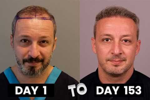 HAIR TRANSPLANT TIMELAPSE | DAY 1 TO DAY 153 | GROWTH IN 5 MONTHS |  BEFORE &amp; AFTER