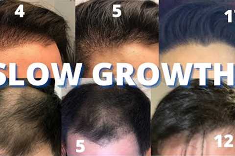Hair Transplant Slow Growers Watch THIS!