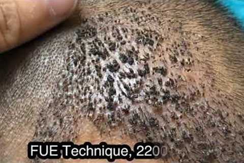 How scalp look after 10th day of Hair Transplant?