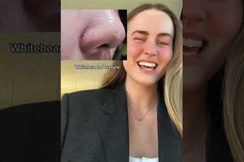 Oily skin, large pores, blackheads &amp; whiteheads!