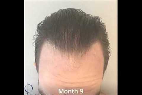 TimeLapse of Hair Transplant Growth