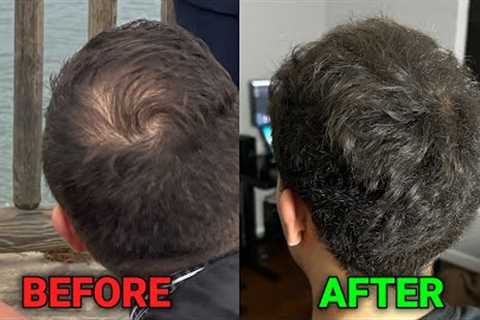 how i reversed balding