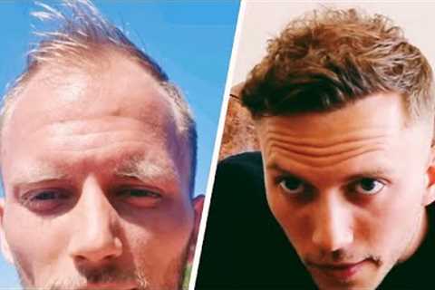 1 Year Hair Transplant Timeline - Day 0 to 365