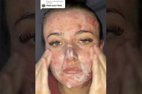 ACNE TIPS THAT WORK!😱 (follow for more!💗) #acne #acnetreatment #skincare #skincareroutine #skin