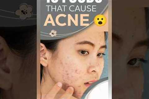 Oily acne prone skin care | oily skin |Acne treatment #shorts #youtubeshorts #short