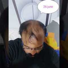 hair regrowth 4 months result without hair transplant