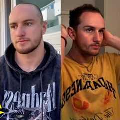 TikTok influencer who started losing hair at 19 breaks stigma around male hair loss l GMA