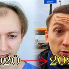 FUE Hair Transplant Growth Timeline | Before & After