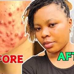 How to Clear Acne and Pimples Fast on face/ Clear acne Scars and dark Spots on face/acne treatment