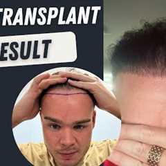 Hair Transplant Before and After 3000 Grafts Result 10 months | Hair Transplant Timelapse