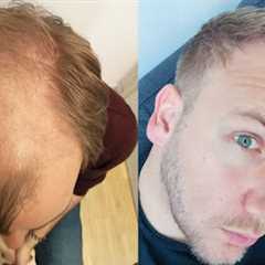 Hair Transplant Before and After - Month by Month results Elithair #8