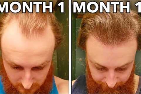 How To Reverse Hair Loss In 12 Months