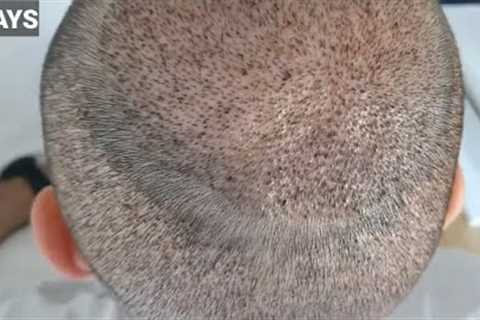 FUE Hair Transplant Timeline | Month 1 to 6 | Before &amp; After