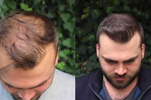 Hair Transplant Result with 3040 Grafts | EXTREME TRANSFORMATION from 0 days to 10 Months