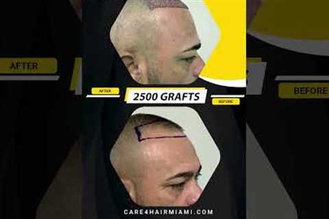 Hair Transplant in our patient. 2500 grafts | Care4Hair