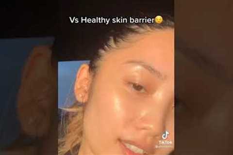 FROM ACNE TO CLEAR SKIN JOURNEY |SKINCARE TIKTOK #SHORTS