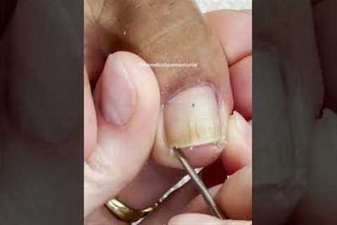 Pedicure on Fungal Toenails before &amp; after 1st visit