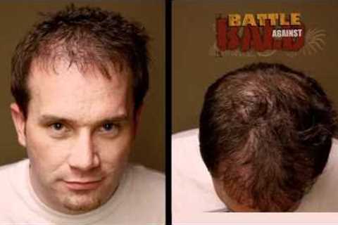 Hair Transplant Results - 12 Month Time-lapse Before and After - Bosley Medical