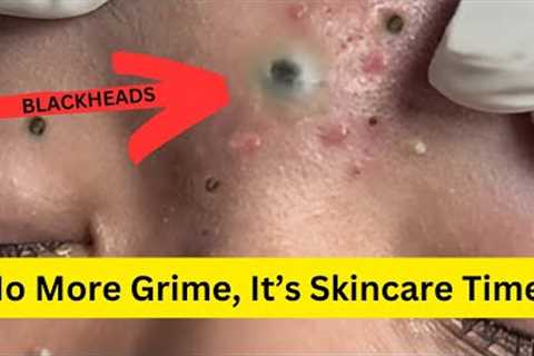 Zits and Blackheads