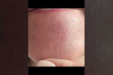 These chin bumps can be frustrating #beautytips #skincare #acne #pores