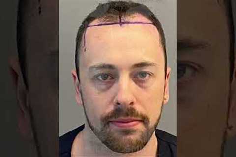 Hair Transplant Before and After of Matthew! 6 MONTHS / 5000 Grafts