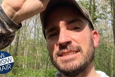 1 YR of Hair Transplant Selfies: Watch it Grow!