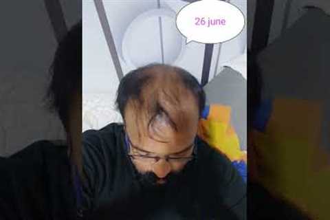 hair regrowth 4 months result without hair transplant