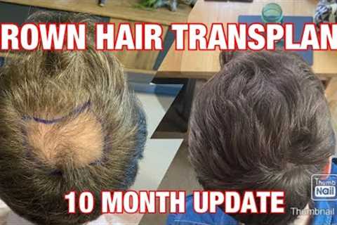 SUCCESSFUL CROWN HAIR TRANSPLANT - FUE surgery in Turkey | Finasteride & Minoxidil - MONTH 10..