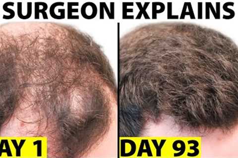 Oral Minoxidil - A Better Hair Loss Treatment?