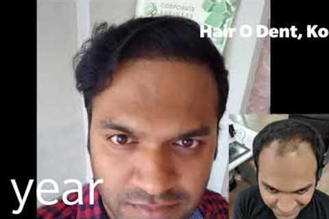 Kerala Hair Transplant results Timelapse | 10 days - 1 year progress | 3000 grafts