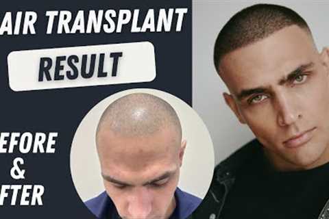 Hair Transplant Before and After |  Hair Transplant Result | Hair Transplant Timelapse