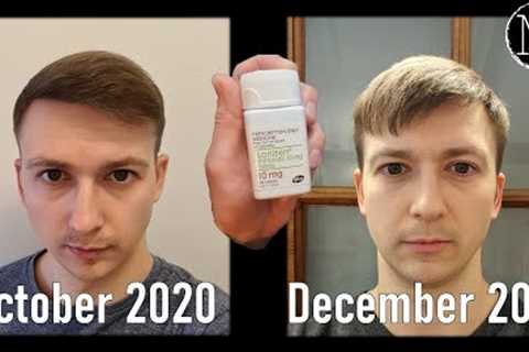 Oral Minoxidil for Hair Loss: My Personal Journey