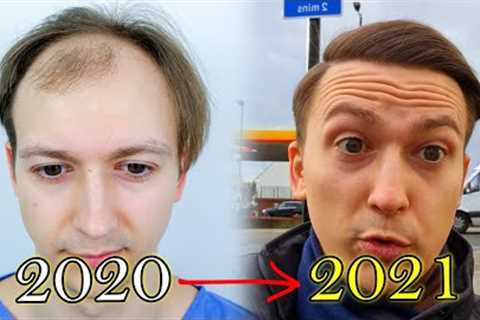 FUE Hair Transplant Growth Timeline | Before &amp; After