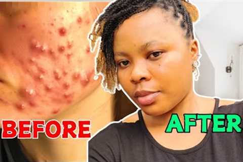 How to Clear Acne and Pimples Fast on face/ Clear acne Scars and dark Spots on face/acne treatment