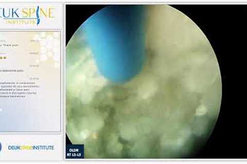 Laser Spine Surgery - Herniated Discs - Back Pain - L3-L4, L4-L5
