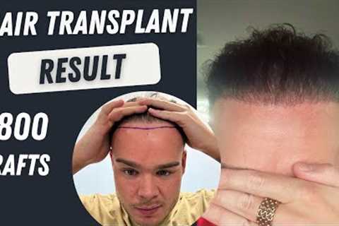 Hair Transplant Before and After 3000 Grafts Result 10 months | Hair Transplant Timelapse