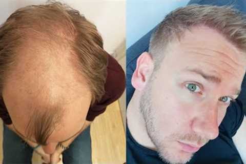 Hair Transplant Before and After - Month by Month results Elithair #8