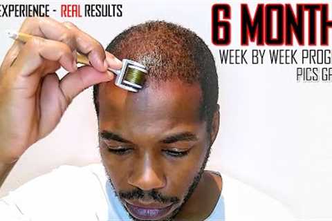 Derma roller Hair Regrowth Results 6 Months | Month by Month Progress | Coffee as a DHT Blocker