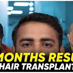 Hair Transplant in Vijayapura | Best Results & Cost of Hair Transplant in Vijayapura