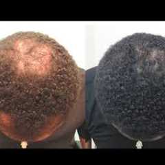 Hair Loss Treatment for Men - Black Men Hair Loss no Surgery