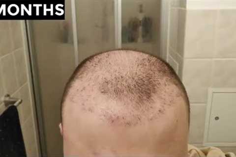My 2 Hair Transplants Results Timeline | Before and After