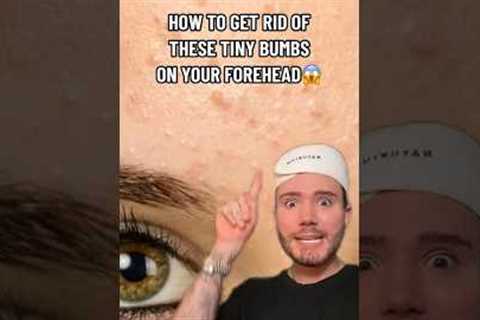 HOW TO GET RID OF FORHEAD BUMPS!😱(follow for more💗) #skincare #acne #skin #skincareroutine #beauty