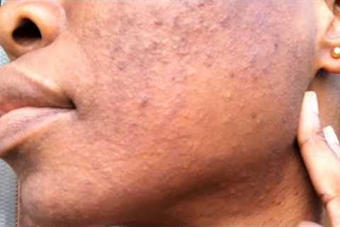 HOW I TREATED MY FUNGAL ACNE (Malassezia) FAST | THE BEST WAY!
